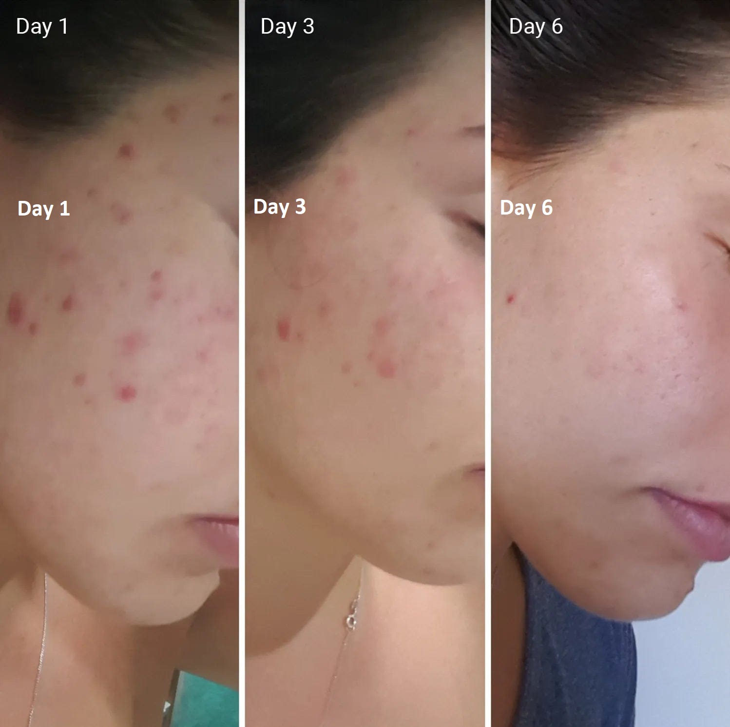 Acne Transformation